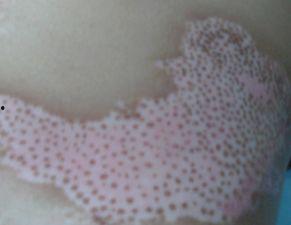 白癜风病人可吃哈密瓜吗,白癜风患者适宜食用哈密瓜吗？