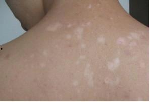 白癜风可以吃瓜吗,西瓜，可以吃吗？